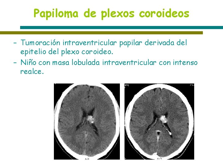 Papiloma de plexos coroideos – Tumoración intraventricular papilar derivada del epitelio del plexo coroideo.