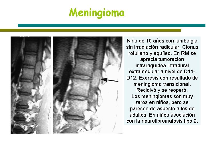 Meningioma Niña de 10 años con lumbalgia sin irradiación radicular. Clonus rotuliano y aquíleo.