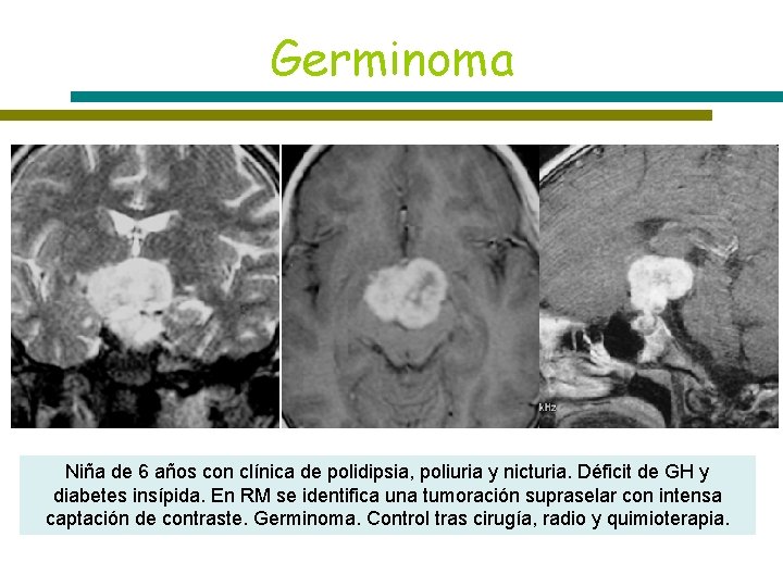 Germinoma T 1 T 2 T 1+C Niña de 6 años con clínica de