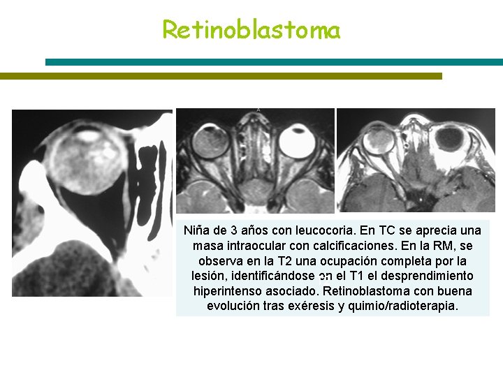 Retinoblastoma Niña de 3 años con leucocoria. En TC se aprecia una masa intraocular