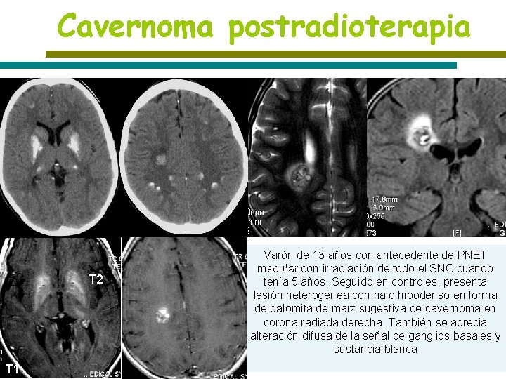 Cavernoma postradioterapia T 2 T 1 Varón de 13 años con antecedente de PNET