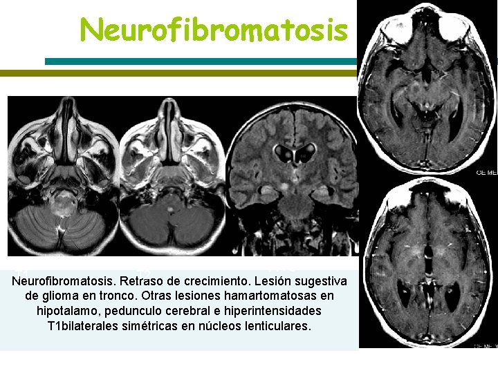 Neurofibromatosis T 1+C T 1 T 2 Neurofibromatosis. Retraso de crecimiento. Lesión sugestiva de