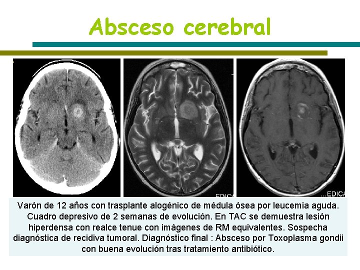 Absceso cerebral T 1 T 2 T 1+C Varón de 12 años con trasplante