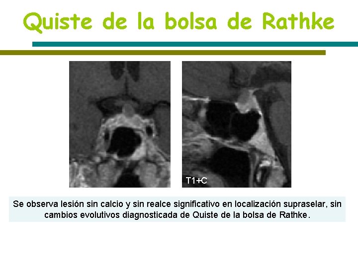 Quiste de la bolsa de Rathke T 1 T 2 T 1+C Se observa