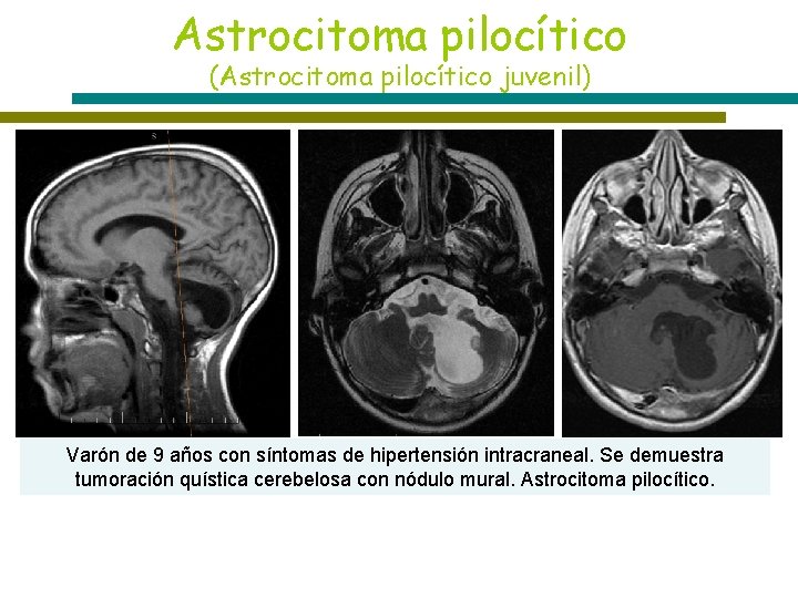 Astrocitoma pilocítico (Astrocitoma pilocítico juvenil) T 1 T 2 T 1+C Varón de 9