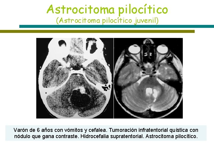 Astrocitoma pilocítico (Astrocitoma pilocítico juvenil) T 1 T 2 T 1+C Varón de 6