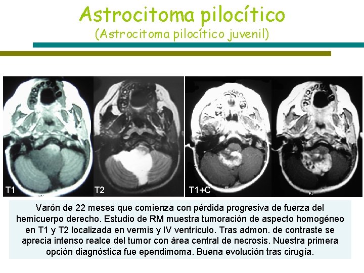 Astrocitoma pilocítico (Astrocitoma pilocítico juvenil) T 1 T 2 T 1+C Varón de 22