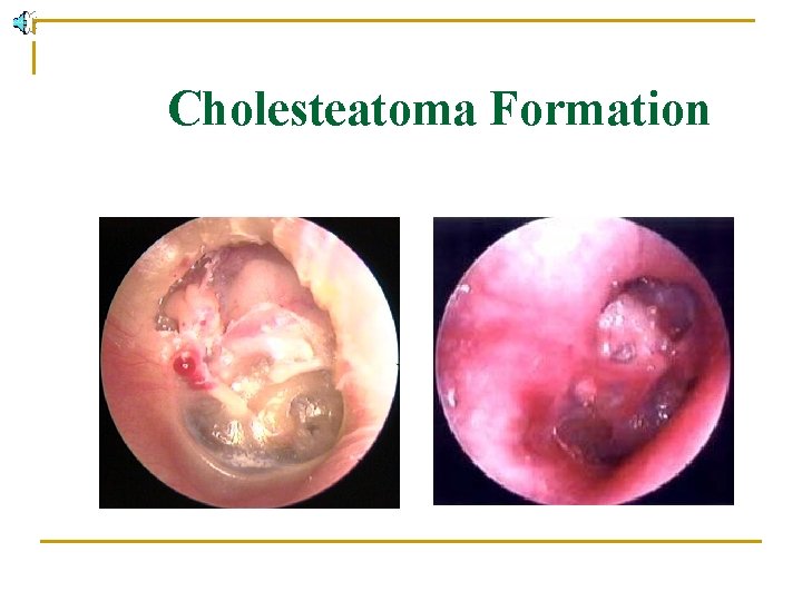 Cholesteatoma Formation 