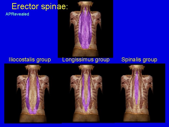 Erector spinae: APRevealed Iliocostalis group Longissimus group Spinalis group 