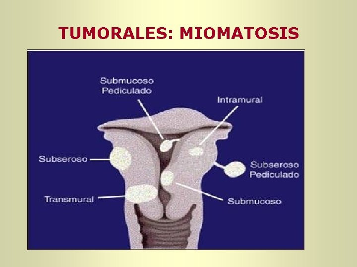 TUMORALES: MIOMATOSIS TUMORALES: MIOMATOSIS
