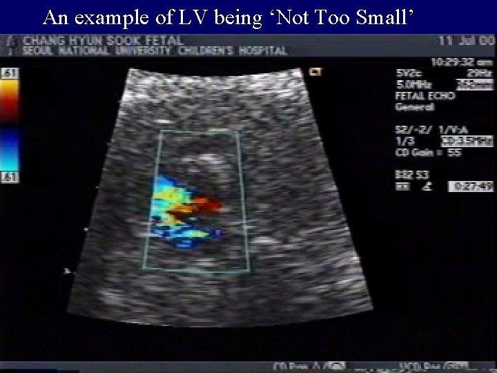 An example of LV being ‘Not Too Small’ 