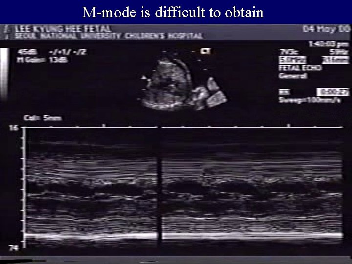 M-mode is difficult to obtain 
