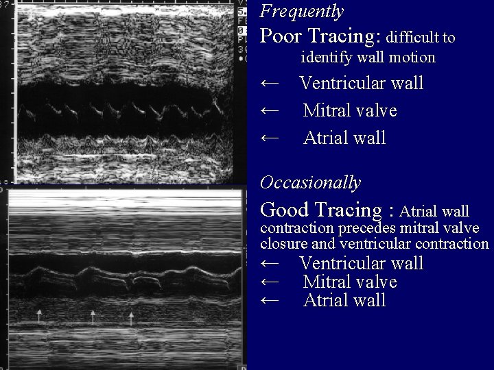 Frequently Poor Tracing: difficult to identify wall motion ← Ventricular wall ← Mitral valve