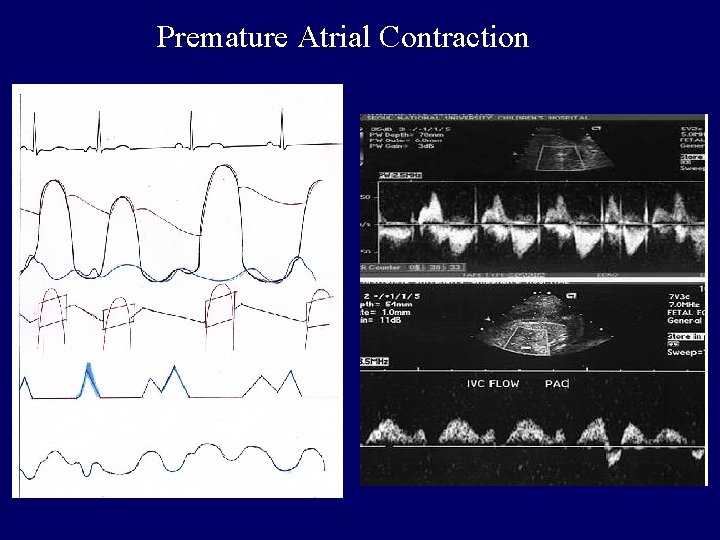Premature Atrial Contraction 