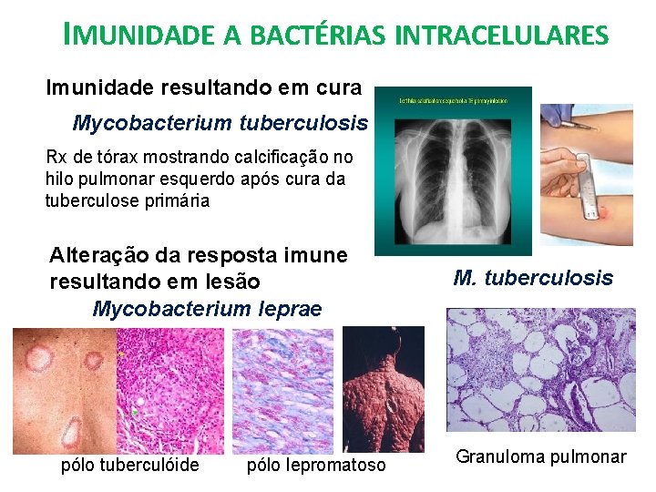 IMUNIDADE A BACTÉRIAS INTRACELULARES Imunidade resultando em cura Mycobacterium tuberculosis Rx de tórax mostrando