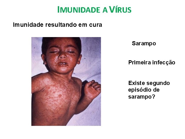 IMUNIDADE A VÍRUS Imunidade resultando em cura Sarampo Primeira infecção Existe segundo episódio de