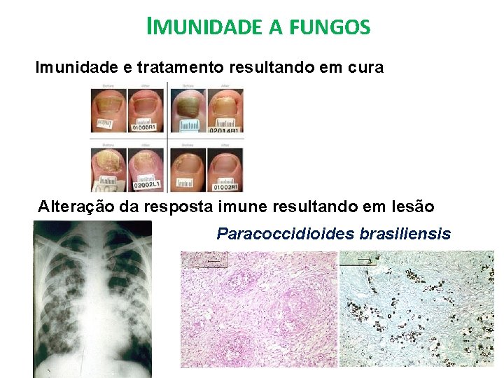 IMUNIDADE A FUNGOS Imunidade e tratamento resultando em cura Alteração da resposta imune resultando