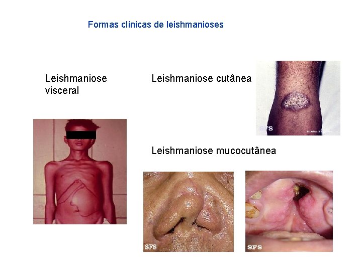 Formas clínicas de leishmanioses Leishmaniose visceral Leishmaniose cutânea Leishmaniose mucocutânea 