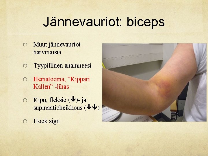 Jännevauriot: biceps Muut jännevauriot harvinaisia Tyypillinen anamneesi Hematooma, ”Kippari Kallen” -lihas Kipu, fleksio (