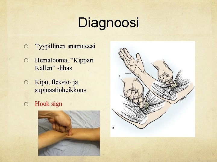 Diagnoosi Tyypillinen anamneesi Hematooma, ”Kippari Kallen” -lihas Kipu, fleksio- ja supinaatioheikkous Hook sign 