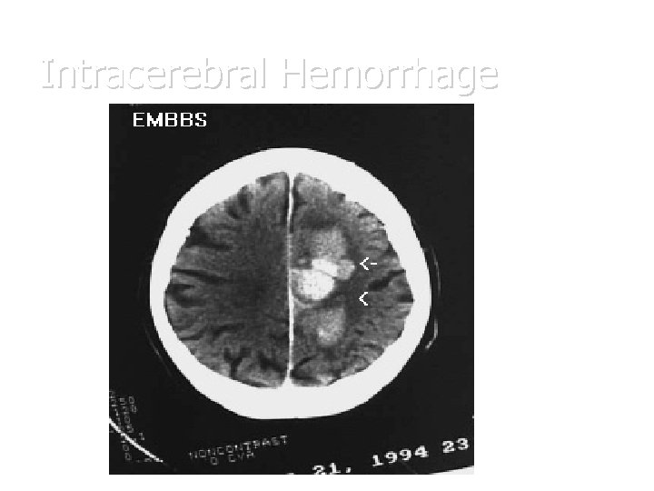 Intracerebral Hemorrhage 