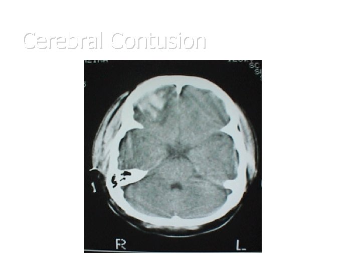 Cerebral Contusion 