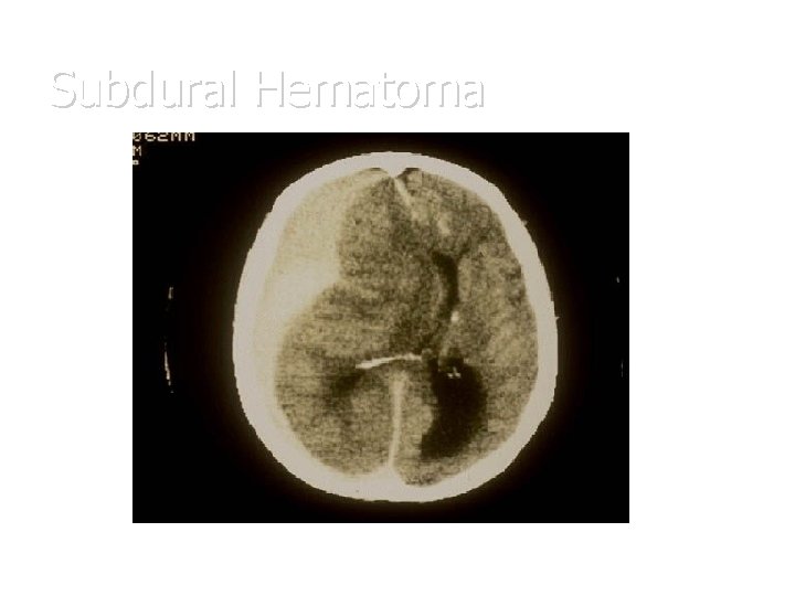 Subdural Hematoma 