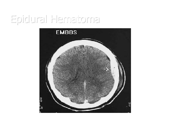 Epidural Hematoma 