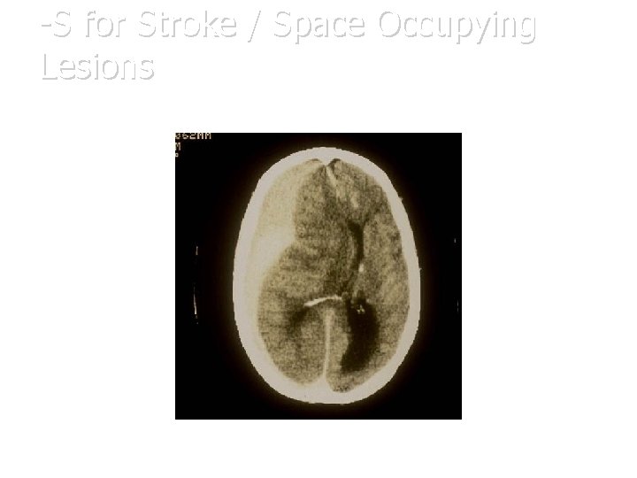 -S for Stroke / Space Occupying Lesions 