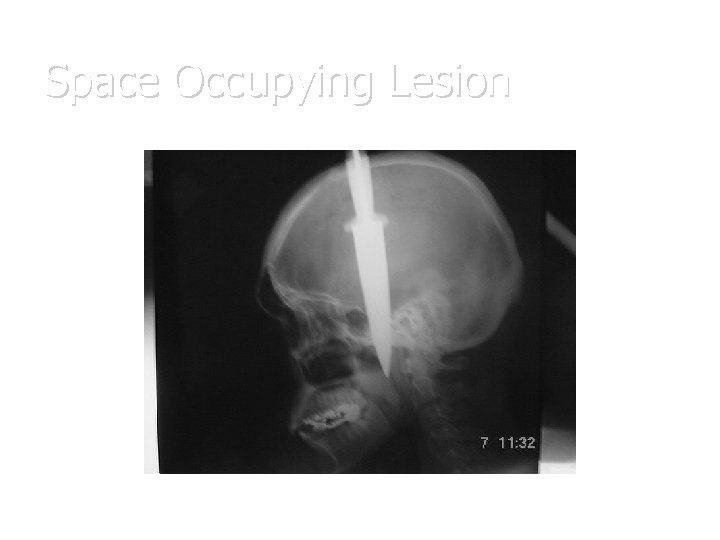 Space Occupying Lesion 