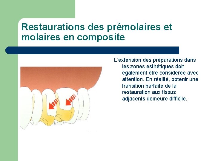 Restaurations des prémolaires et molaires en composite L’extension des préparations dans les zones esthétiques Restaurations des prémolaires et molaires en composite L’extension des préparations dans les zones esthétiques