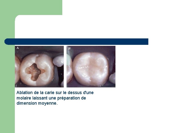Ablation de la carie sur le dessus d'une molaire laissant une préparation de dimension Ablation de la carie sur le dessus d'une molaire laissant une préparation de dimension