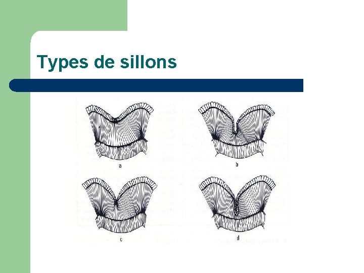 Types de sillons Types de sillons