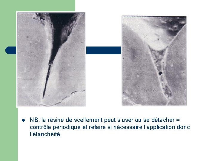 l NB: la résine de scellement peut s’user ou se détacher = contrôle périodique l NB: la résine de scellement peut s’user ou se détacher = contrôle périodique