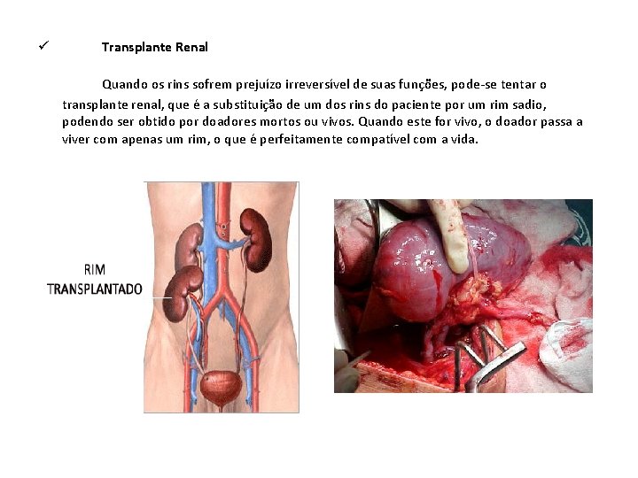 Transplante Renal ü Quando os rins sofrem prejuízo irreversível de suas funções, pode-se tentar