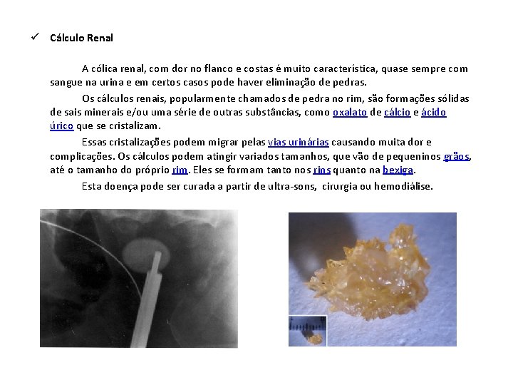  ü Cálculo Renal A cólica renal, com dor no flanco e costas é