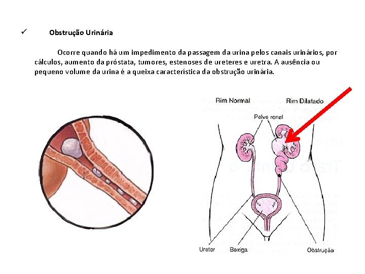 ü Obstrução Urinária Ocorre quando há um impedimento da passagem da urina pelos canais