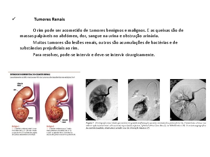 ü Tumores Renais O rim pode ser acometido de tumores benignos e malignos. E