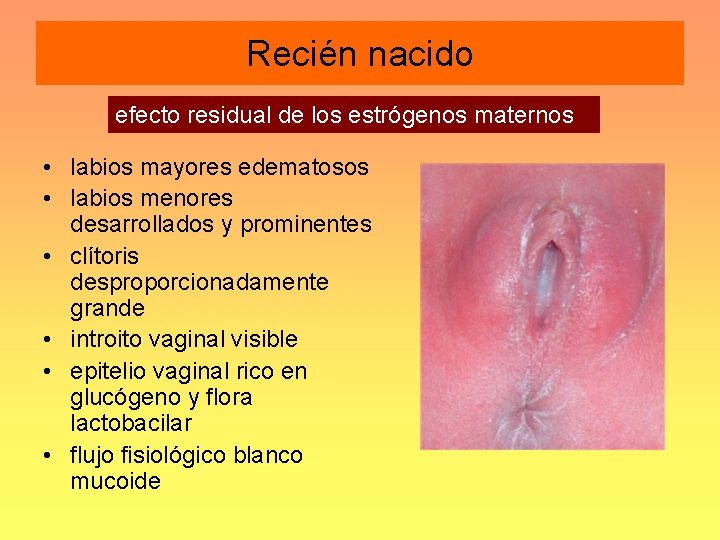 Recién nacido efecto residual de los estrógenos maternos • labios mayores edematosos • labios