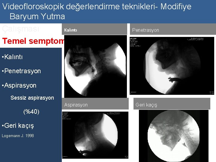 Videofloroskopik değerlendirme teknikleri- Modifiye Baryum Yutma Kalıntı Çalışması Penetrasyon Temel semptomlar • Kalıntı •