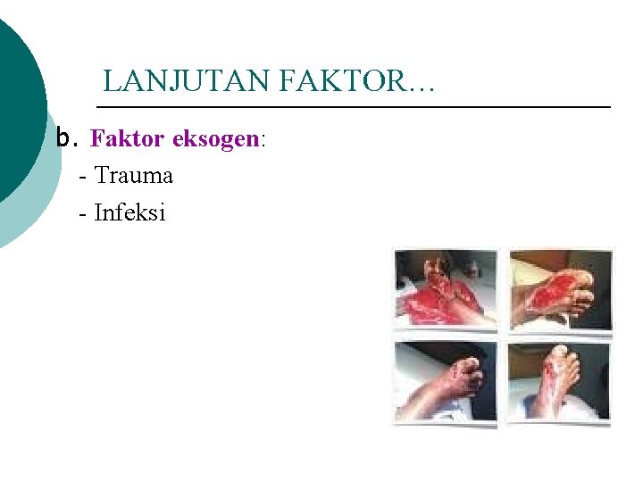 LANJUTAN FAKTOR… b. Faktor eksogen: - Trauma - Infeksi 