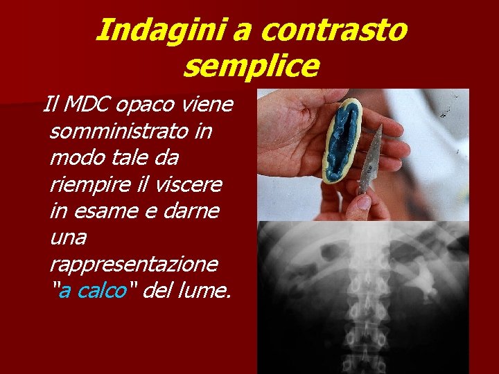 Indagini a contrasto semplice Il MDC opaco viene somministrato in modo tale da riempire