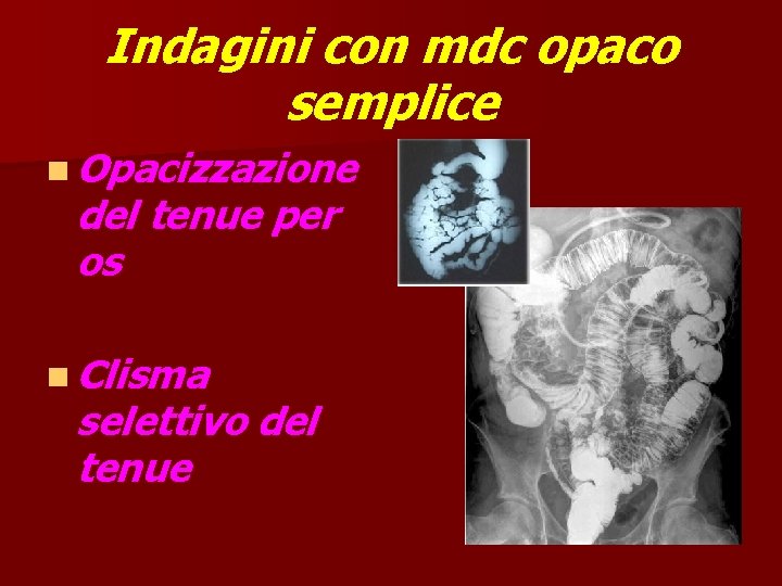 Indagini con mdc opaco semplice n Opacizzazione del tenue per os n Clisma selettivo