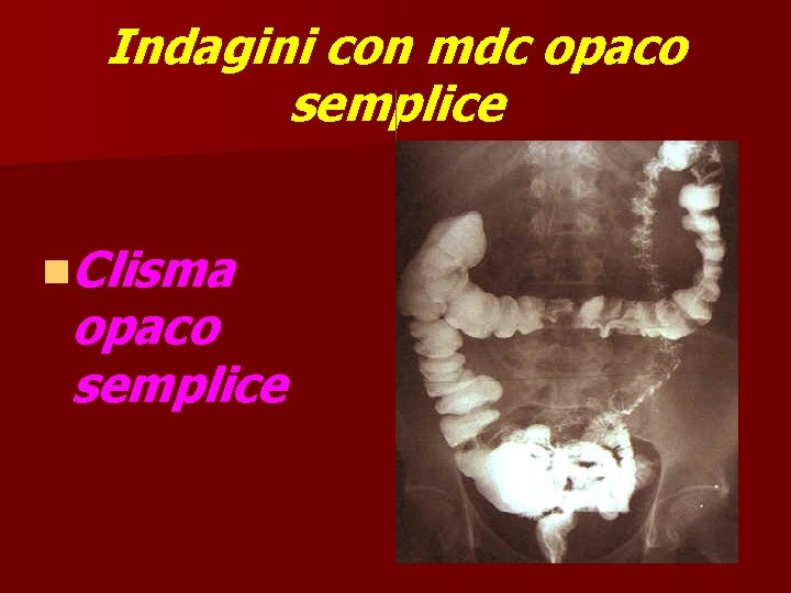 Indagini con mdc opaco semplice n. Clisma opaco semplice 