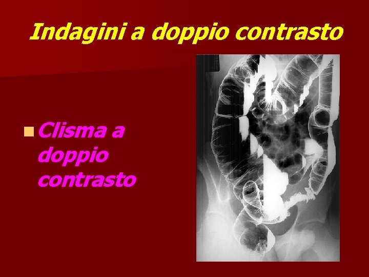 Indagini a doppio contrasto n Clisma a doppio contrasto 