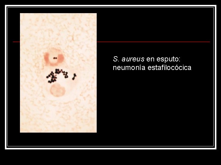 S. aureus en esputo: neumonía estafilocócica 