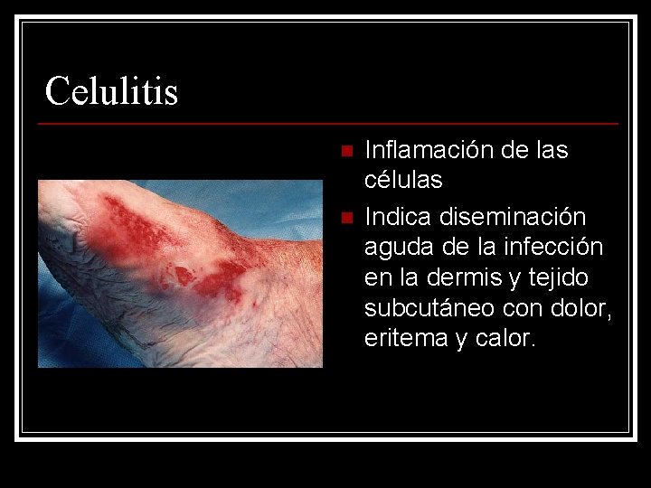 Celulitis n n Inflamación de las células Indica diseminación aguda de la infección en