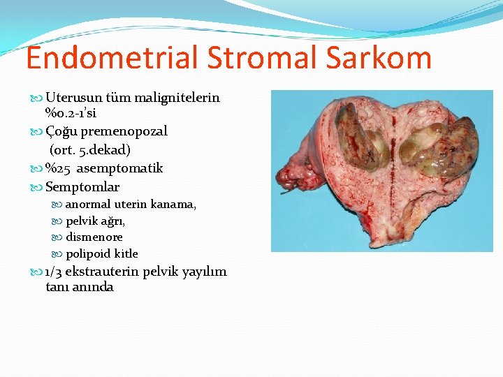 Endometrial Stromal Sarkom Uterusun tüm malignitelerin %0. 2 -1’si Çoğu premenopozal (ort. 5. dekad) Endometrial Stromal Sarkom Uterusun tüm malignitelerin %0. 2 -1’si Çoğu premenopozal (ort. 5. dekad)