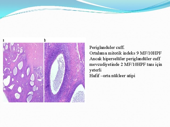 Periglanduler cuff. Ortalama mitotik indeks 9 MF/10 HPF Ancak hiperselüler periglandüler cuff mevcudiyetinde 2 Periglanduler cuff. Ortalama mitotik indeks 9 MF/10 HPF Ancak hiperselüler periglandüler cuff mevcudiyetinde 2