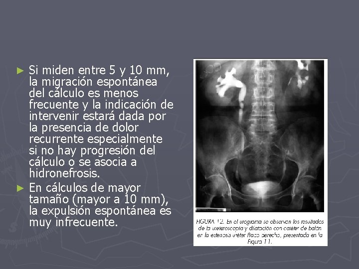 Si miden entre 5 y 10 mm, la migración espontánea del cálculo es menos